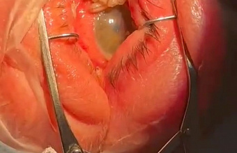 Doctors got 35 worms out of man’s eye in Dagestan